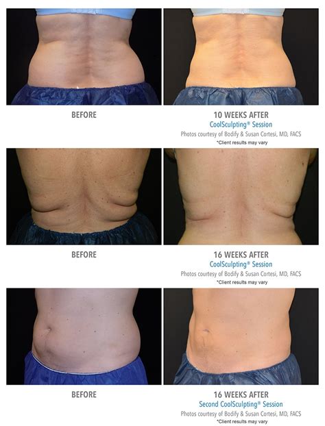 CoolSculpting Before & After Photos | Client Results | Bodify Arizona