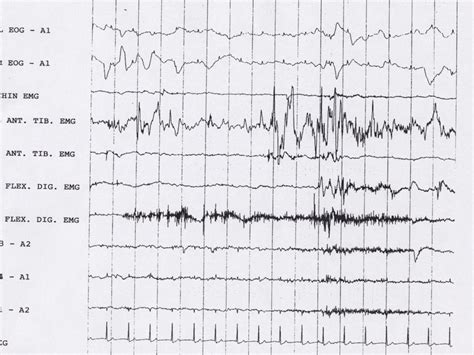 Rem Sleep Behavior Disorder; Rapid Eye Movement Sleep Behavior Disorder