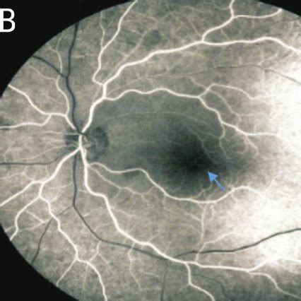 Fluorescein angiography images A: Fluorescein angiography of the left... | Download Scientific ...