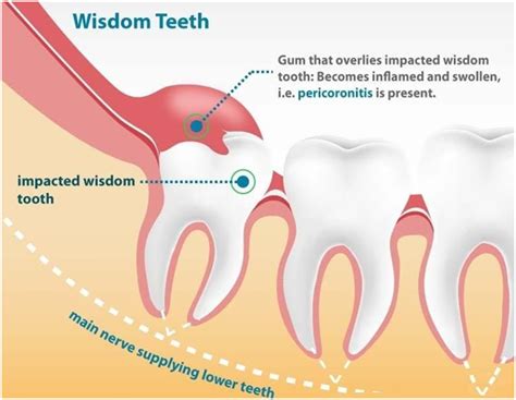 Pericoronitis - WORLD CLASS DENTAL CLINIC, PUNE