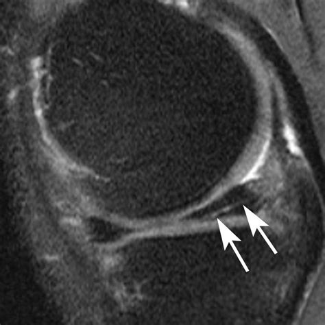 Meniscal Surgery: Common Knee Procedure May Lead To Arthritis And Cartilage Loss | Science 2.0