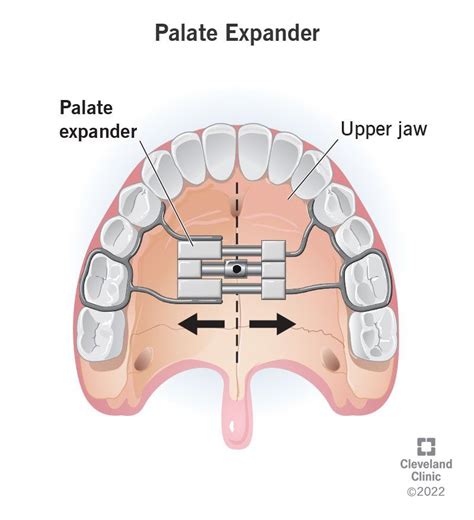 Palate Expander: Uses, Types & Adjusting | Palate expander, Teeth surgery, Dental surgery