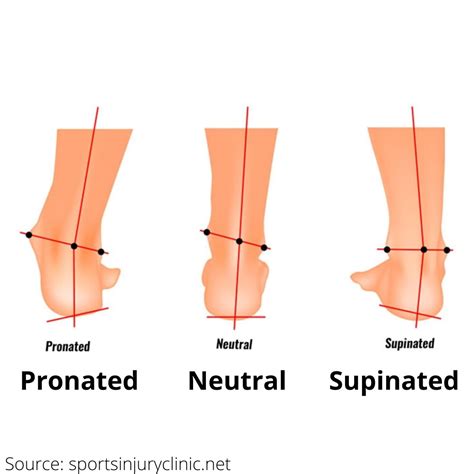 What Causes Pronation Of Foot