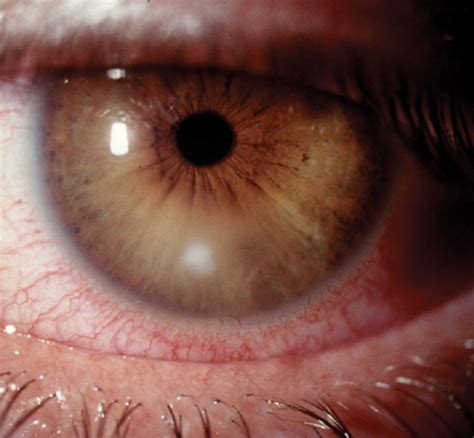 Fighting Corneal Infections With CXL: A New Ally?