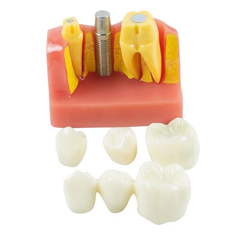 Dental Implant Tools