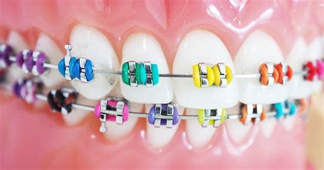 How To Choose The Color Of Your Braces - Nevada Dentistry & Braces