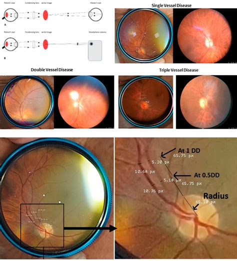 The upper panel shows principles of fundus photography with a ...