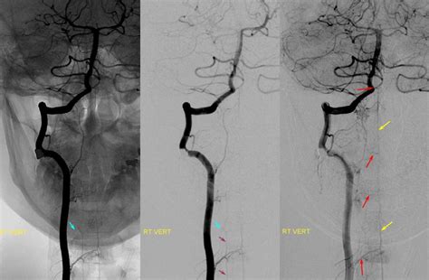 Vertebral Artery | neuroangio.org