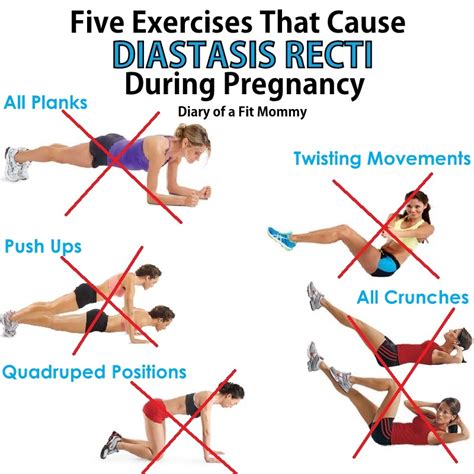 5 Exercises That Cause Diastasis Recti During Pregnancy - Diary of a ...