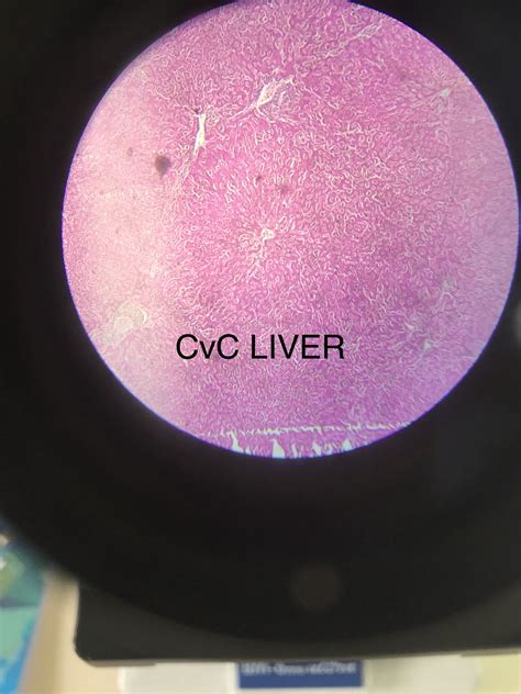 Cvc liver | Cvc, Google home mini, Pathology