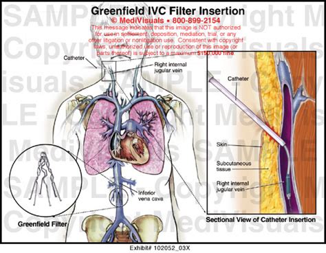 Greenfield IVC Filter Insertion Medical Exhibit Medivisuals