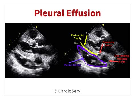 6 Clues to Determining Presence of Cardiac Tamponade Cardioserv