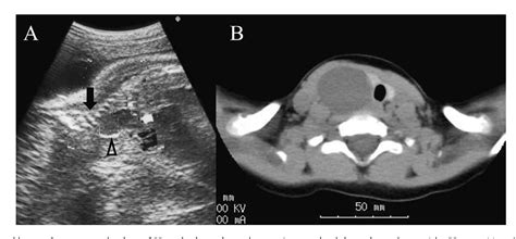 Branchial Cleft Cyst Ultrasound