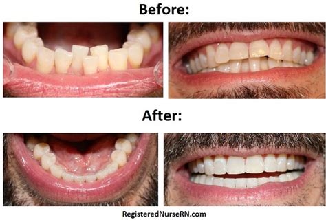 Invisalign (Clear Aligner) Braces Before and After: 3M Clarity