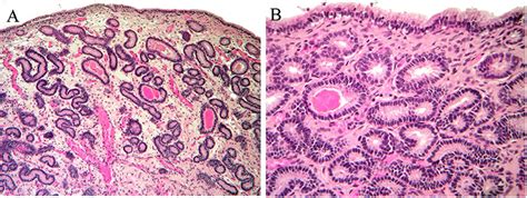 Frontiers | Case Report: Use of Amniotic Microvesicles for Regenerative Medicine Treatment of a ...