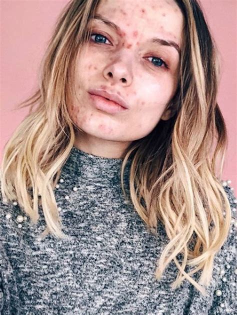 This Blogger Had The Best Response to People Commenting On Her Acne | Acne skin, Natural acne ...