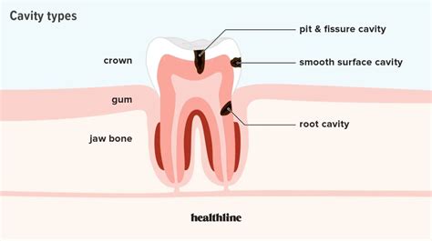 Root Cavity Causes, Symptoms, Diagnosis, and Treatment