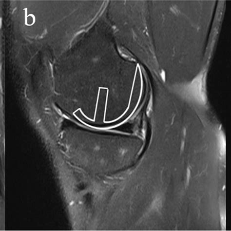 Medial femoral condyle measurement via MRI. a Measurement location in... | Download Scientific ...