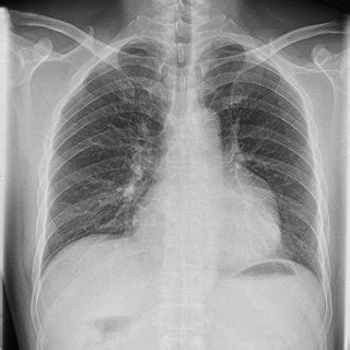 Abnormal Chest X Ray Results