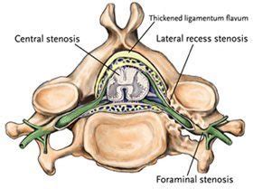 Minimally Invasive Procedures To Treat Foraminal Stenosis – Minnesota Spine Institute