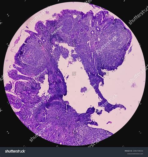 61 Terminal Ileum Images, Stock Photos, 3D objects, & Vectors ...