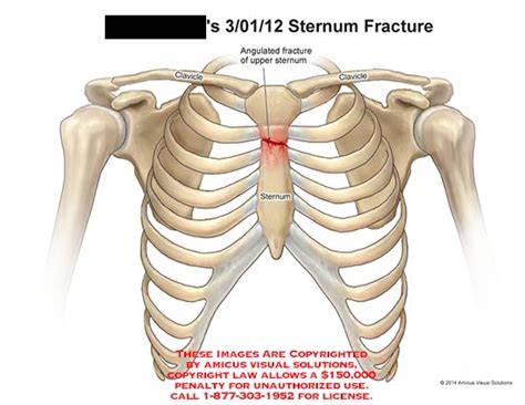 Sternum Fracture