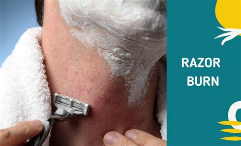 Razor Burn: Causes, Treatment, and More - Resurchify