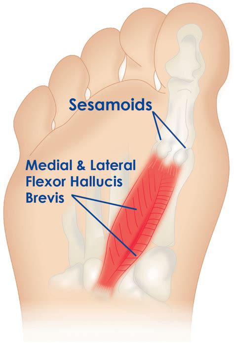 Pain underneath the big toe - is it sesamoiditis? - Be Podiatry