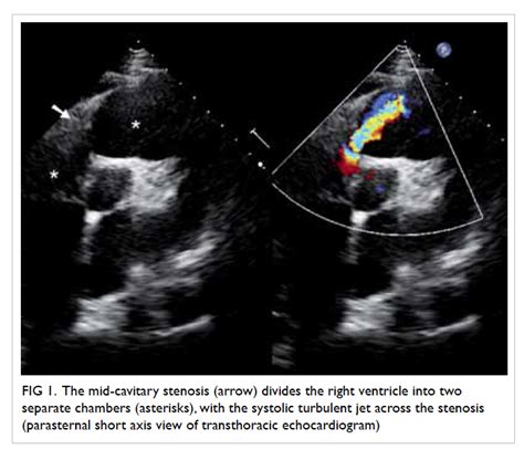 Double-chambered right ventricle: a commonly overlooked diagnosis | HKMJ