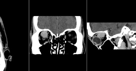 Optic Nerve Sheath Meningioma