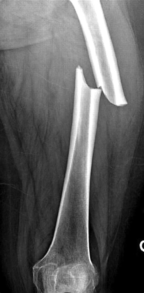 Compound Femur Fractures