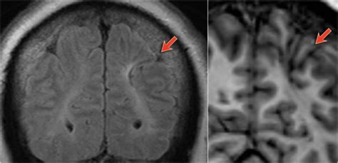 The Radiology Assistant : Brain - Epilepsy: Role of MRI