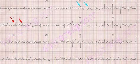 HRV:ECG - OpenWetWare