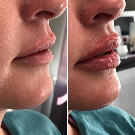 Our new lip filler: Restylane Kysse: Transformed Aesthetic and Wellness Center: Laser & Medical Spa