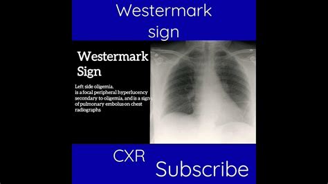 CXR - Westermark Sign - Radiology Review - YouTube