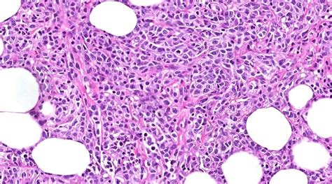 Diffuse large B cell lymphoma (DLBCL) - MyPathologyReport.ca