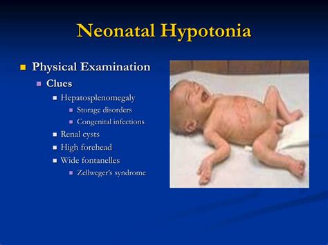 PPT - Neonatal Hypotonia Clinical Approach To Floppy Baby PowerPoint ...