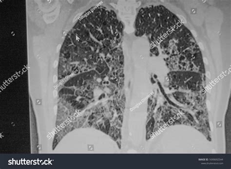 Chest Ct Scan Novel Coronavirus Covid19 Stock Photo 1690692544 | Shutterstock