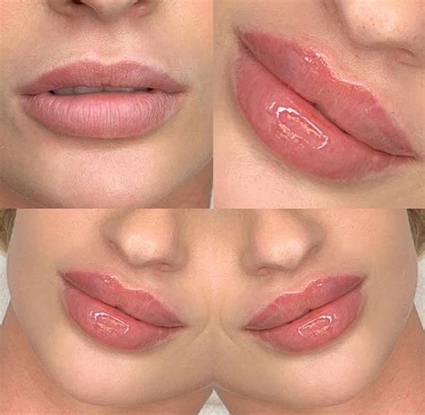 Juvederm Ultra3 2*1ml Hyaluronic Acid Dermal Filler Injection For Lips