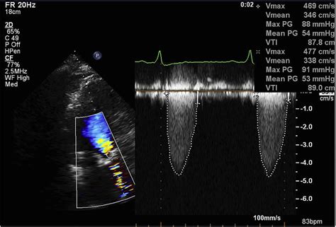 Aortic Valve Echo