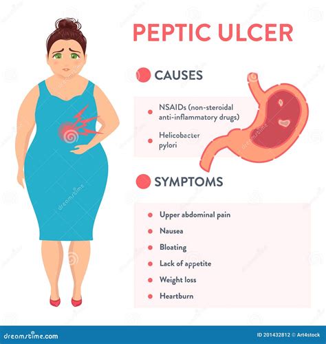 Well Stomach Ulcers Symptoms Peptic Ulcer Ulcer Symptoms | Hot Sex Picture