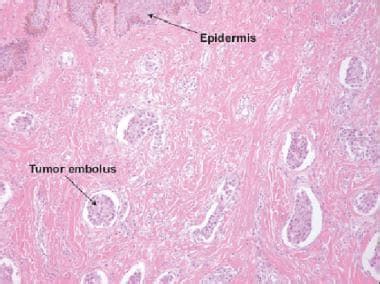 Invasive Ductal Carcinoma Histology