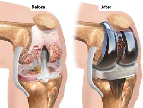 Total Knee Replacement B/L Cost in United Arab Emirates | Orthopedics