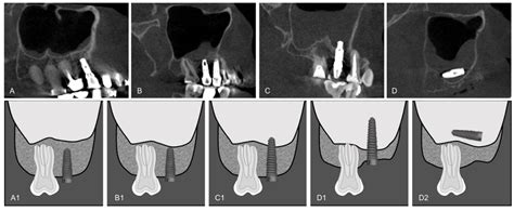 Diagnostics | Free Full-Text | Evaluation of the Maxillary Sinus of Patients with Maxillary ...