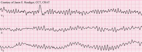 Ventricular Fibrillation