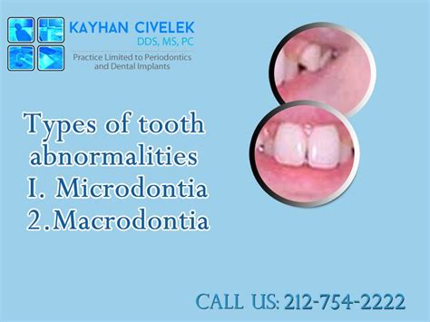 Types of tooth size abnormalities i.microdontia : When tooth is smaller than regular size. ii ...