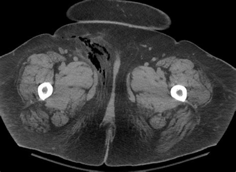 Necrotizing Fasciitis Groin