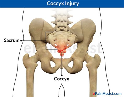 Coccyx Injury and the Ayurvedic Approach - Theayurveda