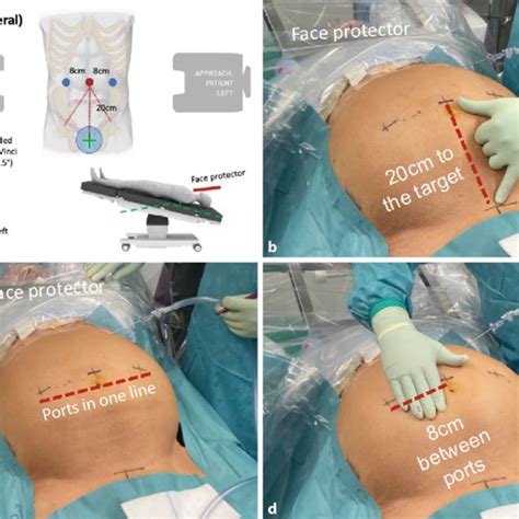 Robotic Inguinal Hernia Repair Anatomy