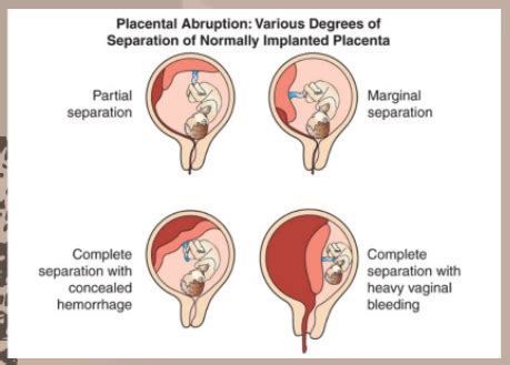 Antepartum/Intrapartum Complications Flashcards | Quizlet